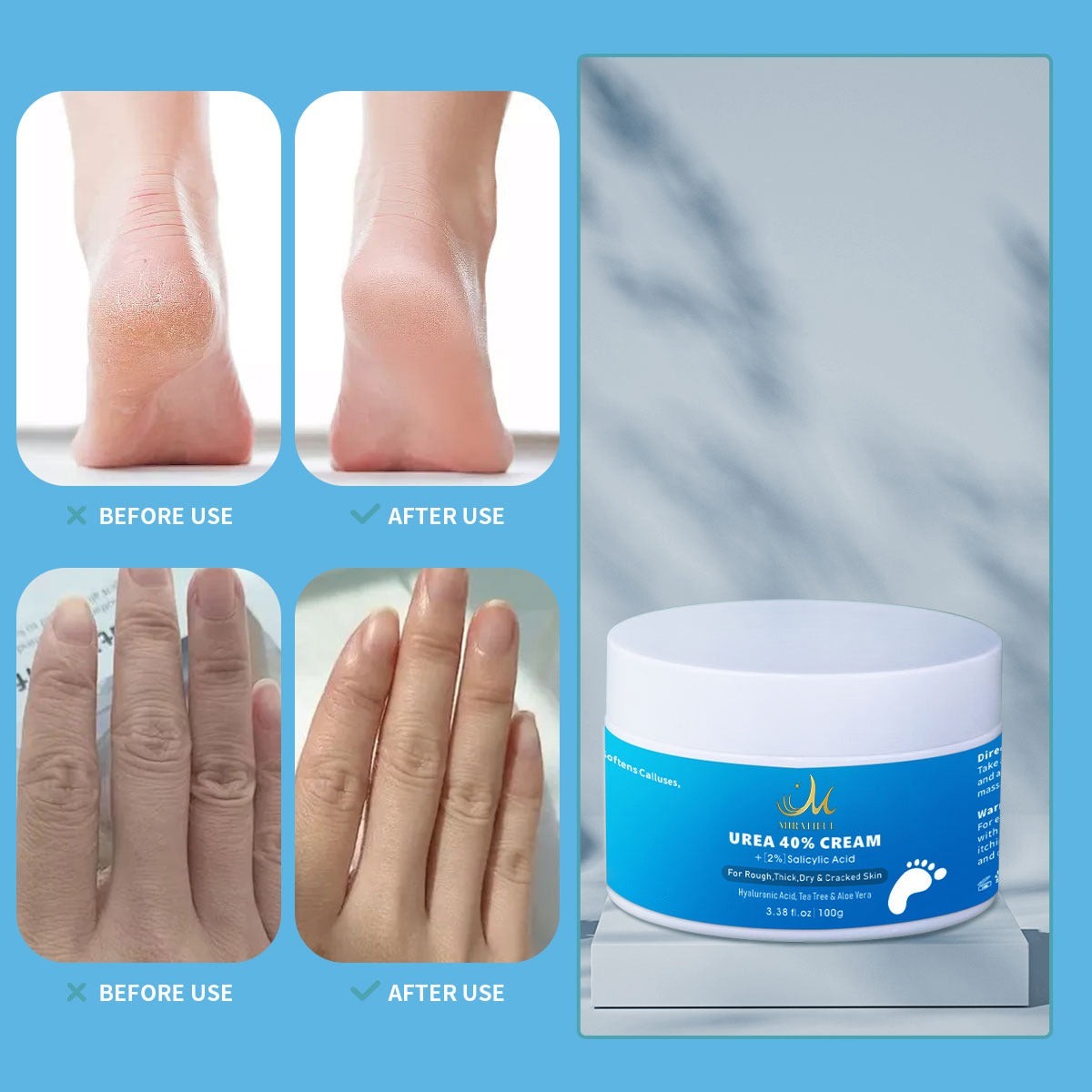Urea Cream 40% For Feet plus Moisturizing Gel for Dry Skin 2% Salicylic Acid