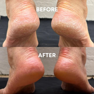 Urea Cream 40% For Feet plus Moisturizing Gel for Dry Skin 2% Salicylic Acid