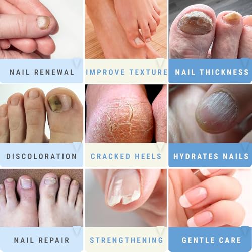 Urea Nail Gel Combo Pack – 50% Urea Daily Treatment & CLEAR 40% Urea Night Gel with Tea Tree Oil – Softens Thick Nails, Repairs Cracked Heels, Whitens Discolored Nails – Quick-Dry – Made in USA